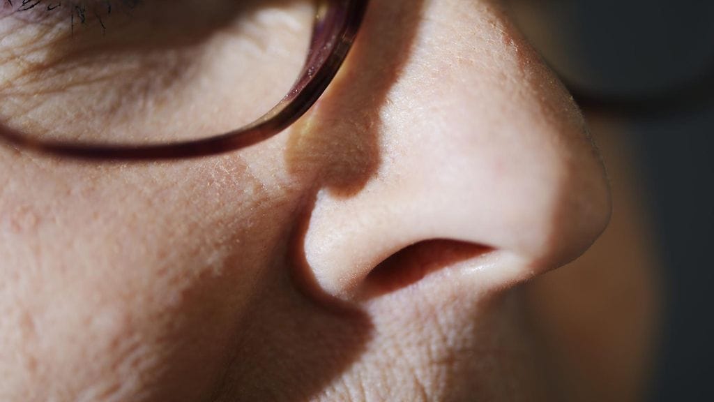 Tutkimuksessa käytännössä kaikki hajuaistinsa menettäneet sairastuivat myöhemmin dementiaan.