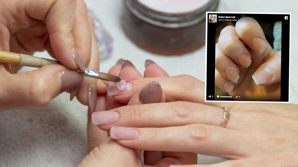 Kynsisalongissa sattunut ikävä välikohtaus jätti naisen kynnet erittäin huonoon kuntoon.