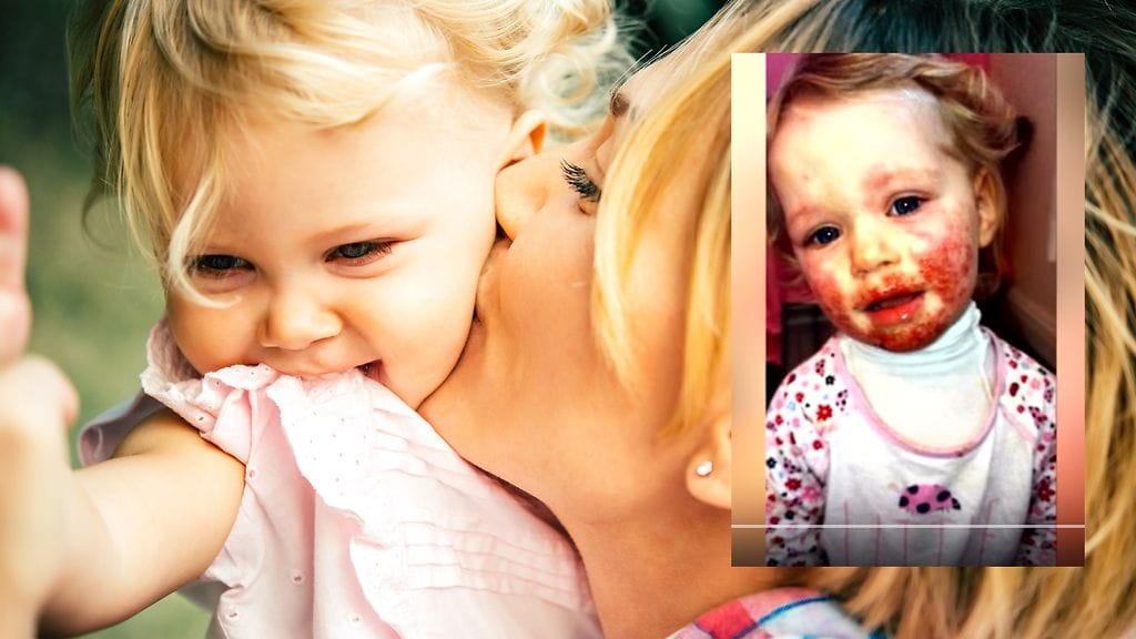 Herpes tarttui kaksivuotiaalle sukulaisen pususta.