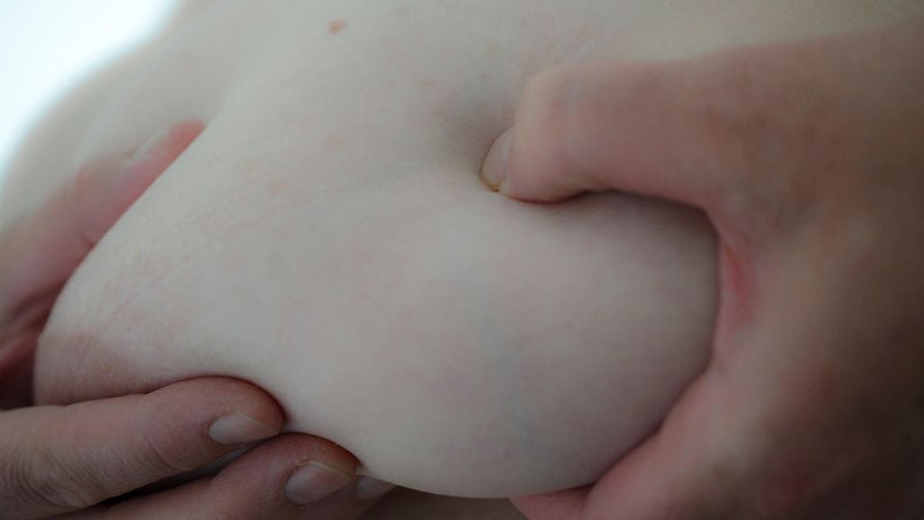 ER-positiivisen rintasyövän uusiutumisriski pysyy pitkään korkealla. Kuvituskuva.