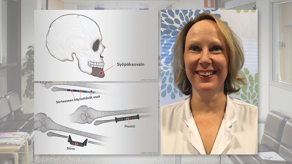 Tampereen yliopistollisessa keskussairaalassa on erityinen, useasta erikoisalasta koostuva ammattilaisjoukko, jonka on erikoistunut hoitamaan pään ja kaulan alueen kasvaimia. Yksi näistä spesialisteista on plastiikkakirurgian ylilääkäri ja dosentti Minna Kääriäinen.