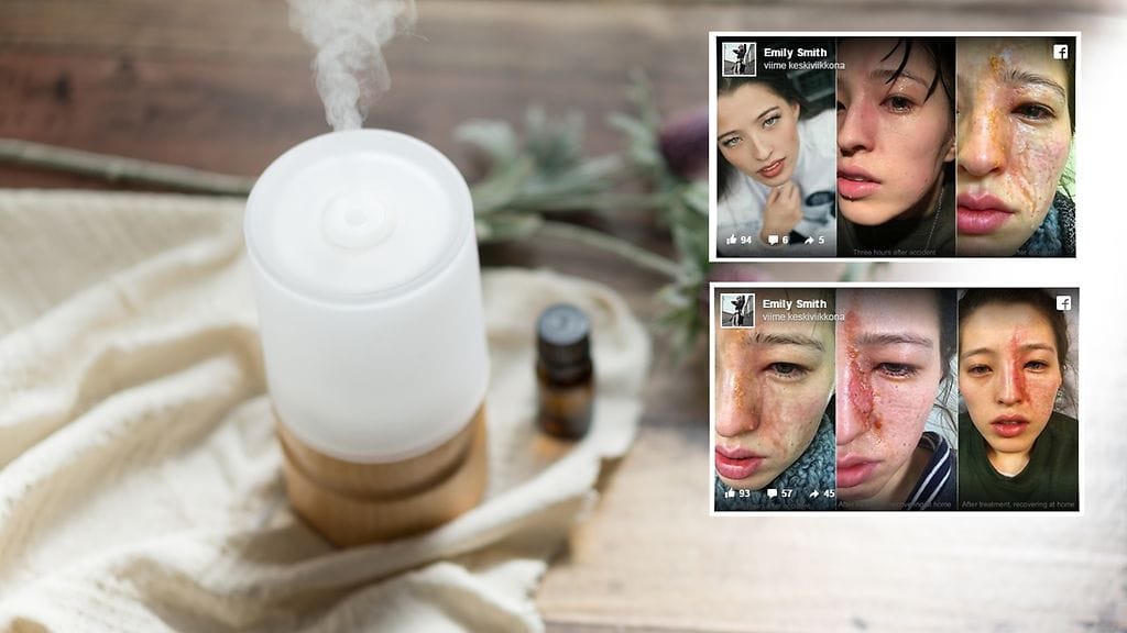 Nainen jakoi kammottavat kuvat eteeristen öljyjen aiheuttamista vammoista.