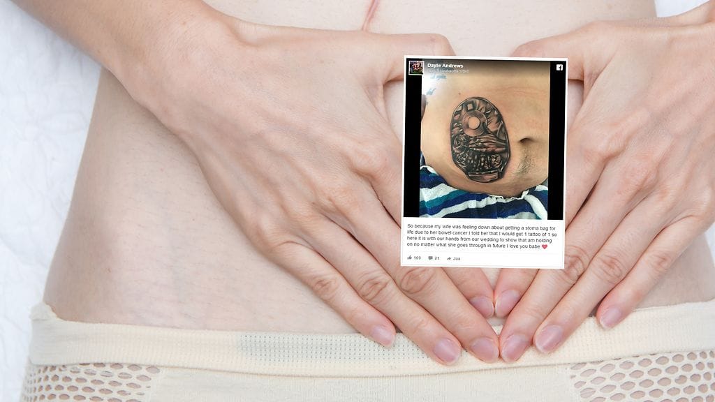 Mies ei halunnut hänen vaimonsa joutuvan kantamaan avannepussin taakkaa yksin.