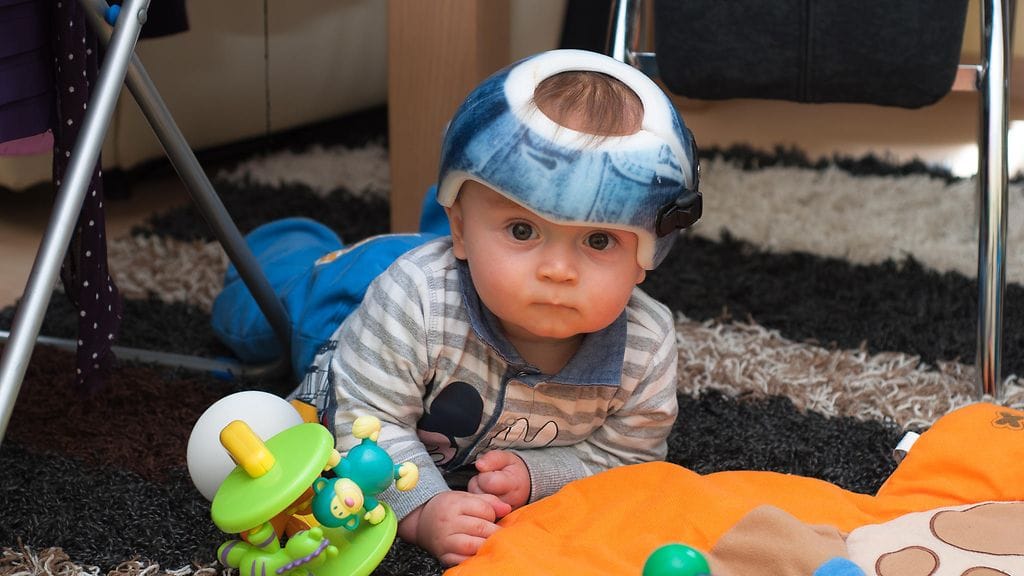 Kypärän toivotaan korjaavan kallon muotoa normaalimmaksi. Kuvituskuva.