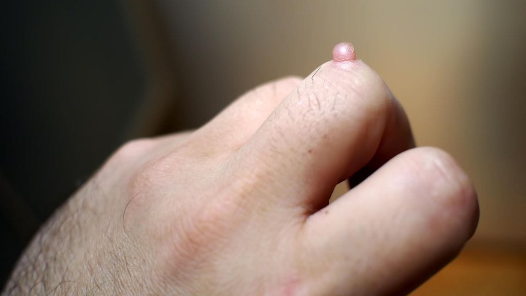 Immuunivasteella on todennäköisesti vaikutusta syylien ilmestymiseen.