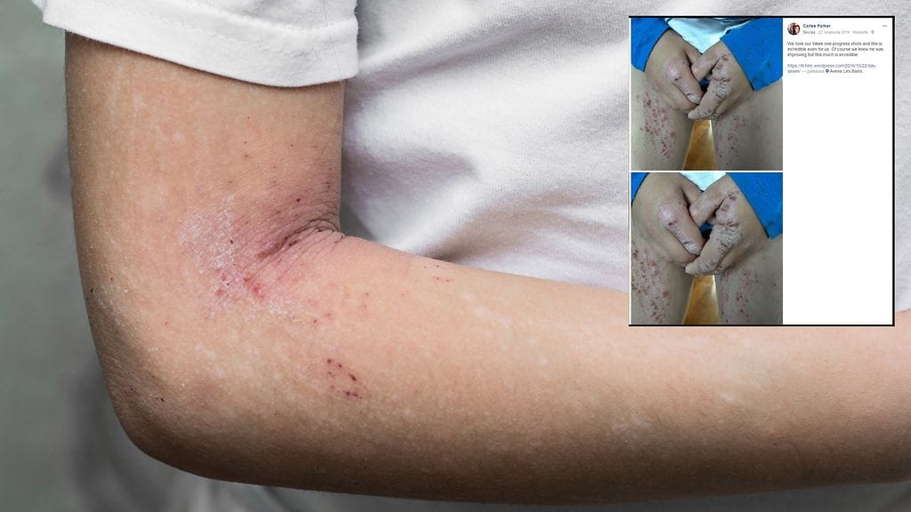 Vakava ihosairaus rajoitti pojan elämää useamman vuoden ajan.