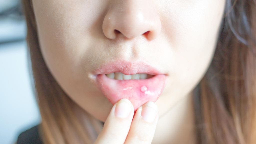 Suun limakalvoille ilmaantuvat aftat voivat olla todella ikävä vaiva.