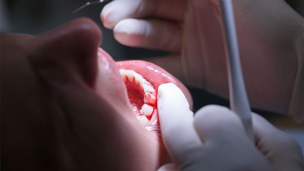 Jos ientulehduksen oireet eivät helpota huolellisesta puhdistuksesta huolimatta, on syytä pistäytyä hammaslääkärissä. Kuvituskuva.