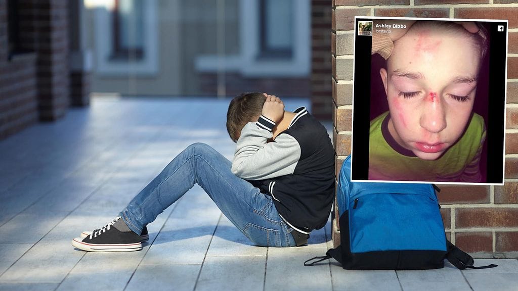 Pojan kokema kiusaaminen on jättänyt hänen kehoonsa fyysisiä vammoja.