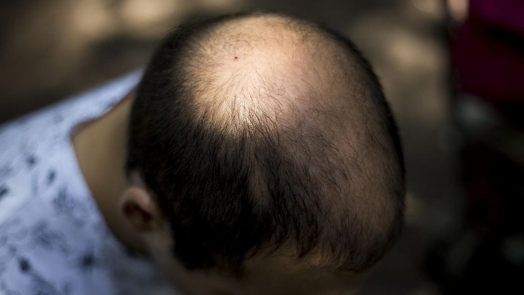 Joiltakin miehiltä alkaa lähteä hiuksia jo alle 20-vuotiaana.