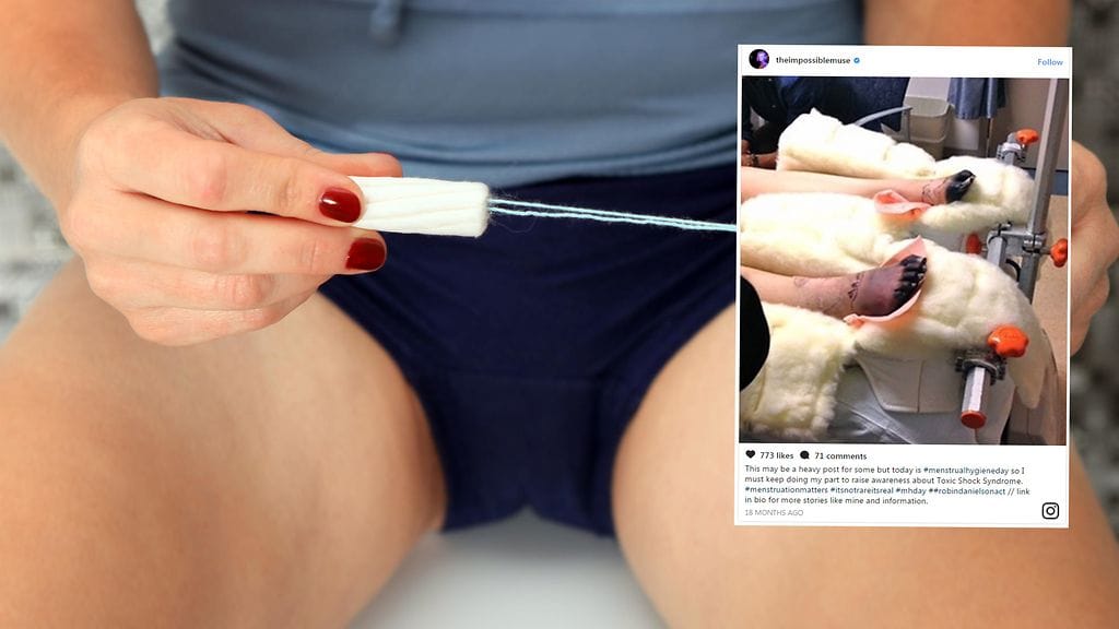 Toksinen sokkiireyhtymä aiheutti nuorelle naiselle hengenvaarallisen tilan.