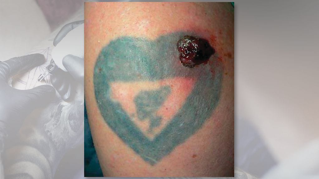 Melanoomaluomi tatuoinnin kohdalla. Kuva: S. Kargel AG, Basel