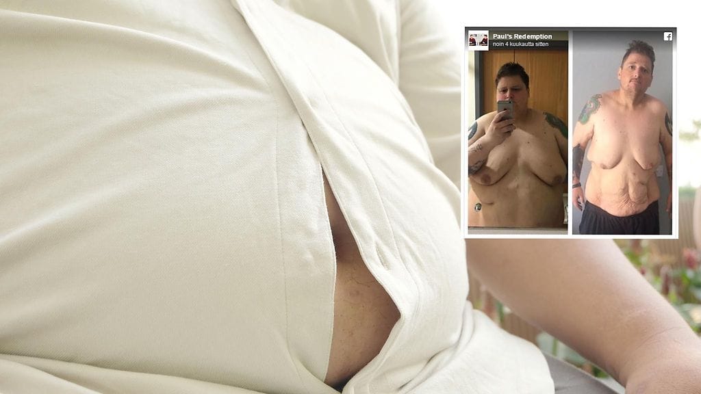 Hurjan muodonmuutoksen kokenut mies toivoo pääsevänsä ihonpoistoleikkaukseen.