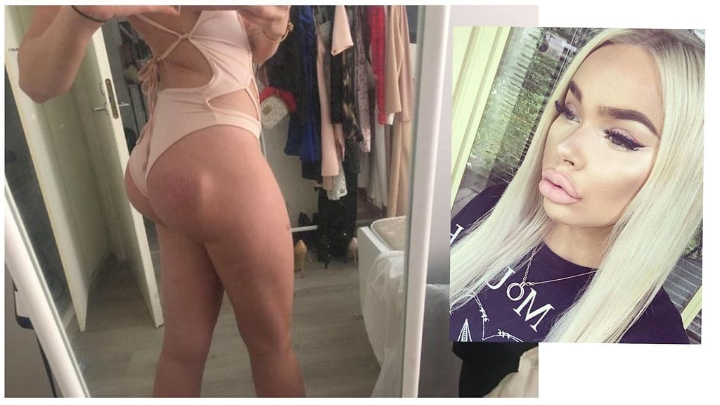 18-vuotiaan Crista Jaatisen peppuoperaatio ei sujunut suunnitelmien mukaan.