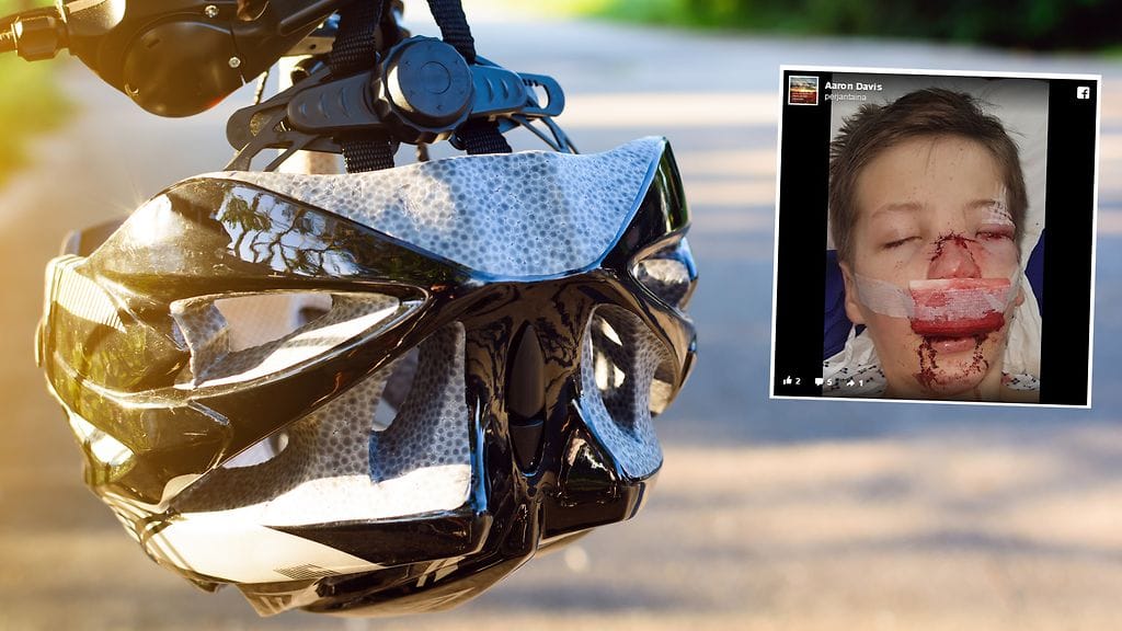 Pyörällä kaatuneen pojan kasvot vaurioituivat onnettomuudessa vakavasti.