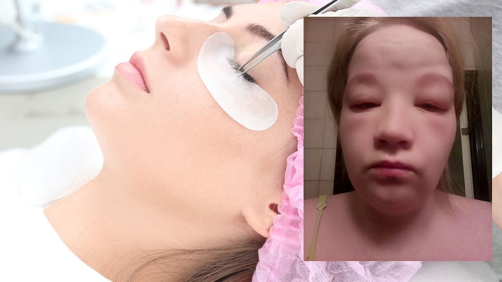 Heidi sai vakavan allergisen reaktion ripsien ja kulmien värjäykseen käytetystä aineesta.
