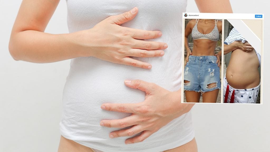 Mallina työskentelevä nainen ei nykyisin anna suolistosairauden rajoittaa elämäänsä .