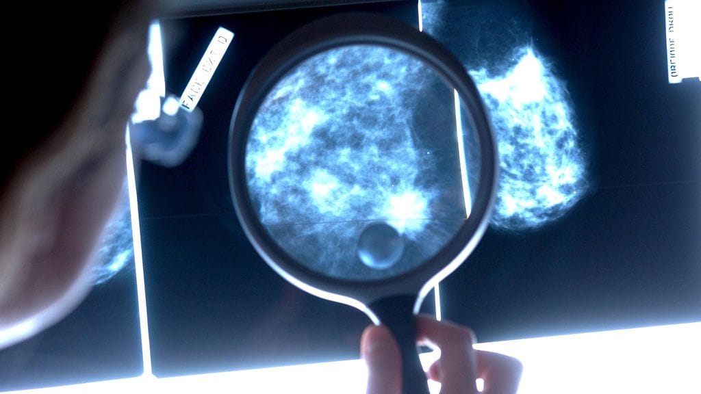 Noin neljännes Suomessa vuosittain todettavista rintasyövistä löytyy mammografiaseulonnoissa. Kuvituskuva.