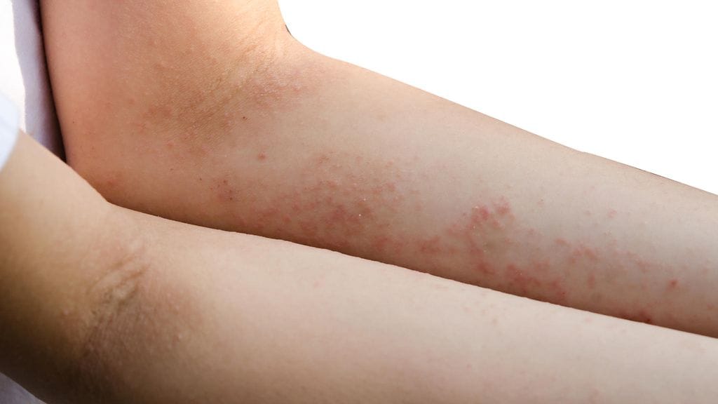 Stressi ja stressaavat elämäntilanteet näyttäisivät suurentavan riskiä sairastua vyöruusuun, japanilaistutkimus osoittaa. Kuvituskuva.