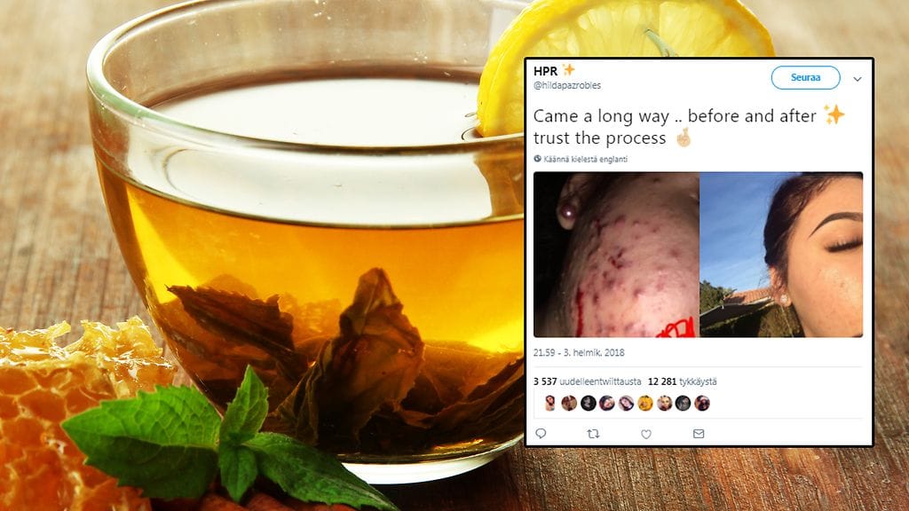 Teinityttö väittää vihreän teen ja hunajan auttaneen aknen katoamisessa.