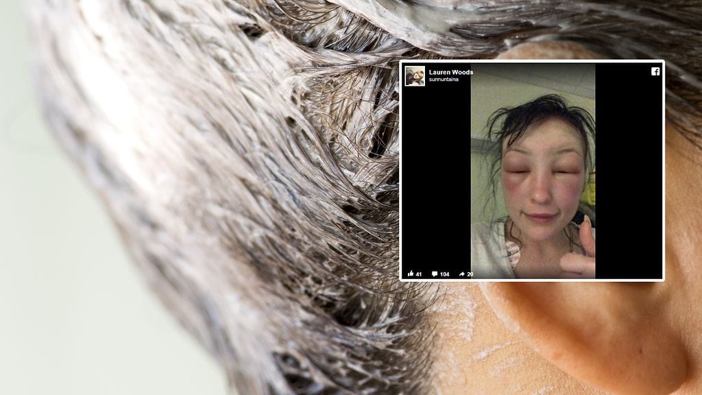 Kotivärjäys meni pahasti pieleen, kun brittinaisetn kasvot turposivat, eikä hän saanut enää silmiäänkään auki.