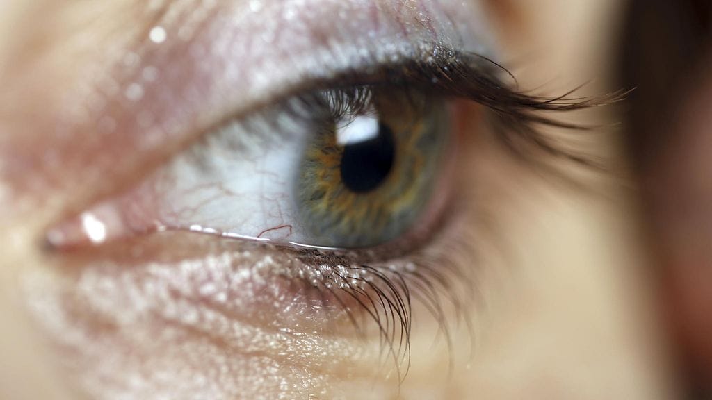 Silmissä voi olla monenlaisia tulehduksia. Kuvituskuva.