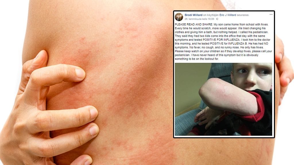 Amerikkalaisnaisen pienellä pojalla ei ihottuman lisäksi ollut muita oireita influenssasta.