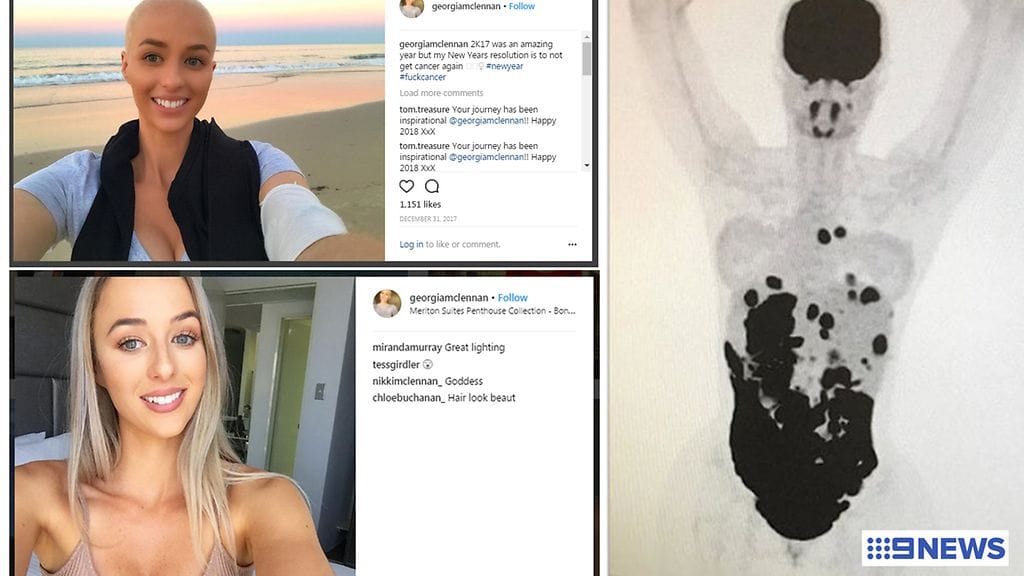 Georgia McLennan vaikutti ulkoisesti terveeltä. Vasta naiselle tehty, koko kehon kuvannut PET-kuvaus paljasti, miten huono tilanne todella oli. Kuvien lähde Instagram ja 9 News