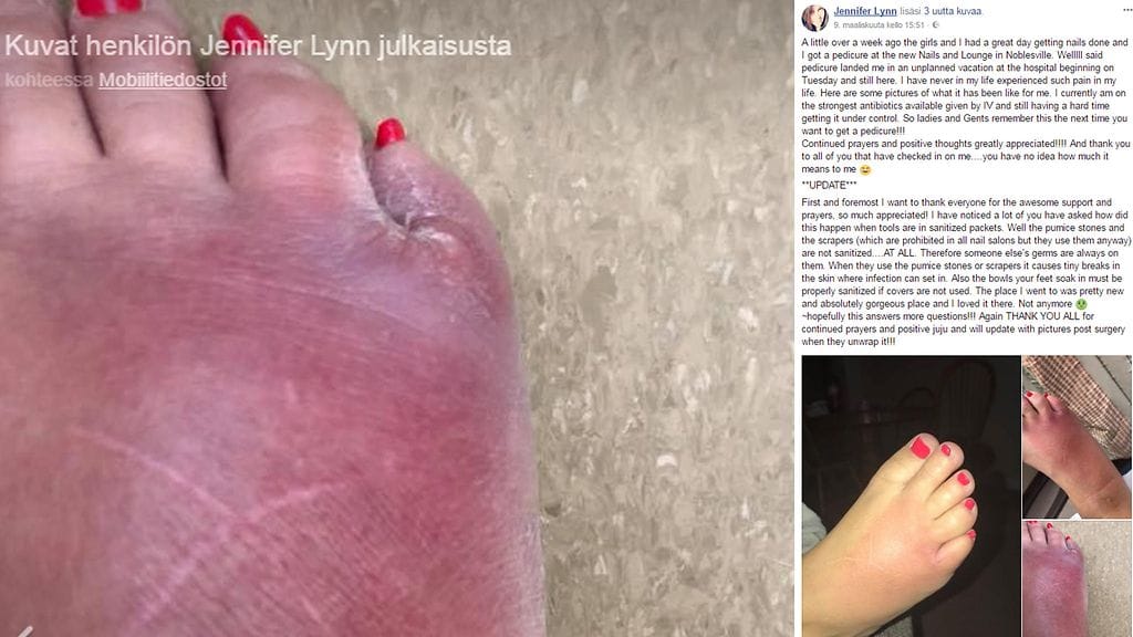 Jennifer White kertoo Facebookissa, että hänen jalkansa on infektion vuoksi jouduttu jopa leikkaamaan. Kuvien lähde Facebook