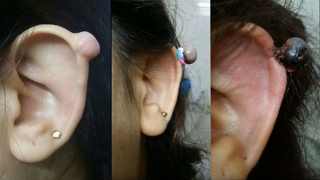 Kasvaneen arpikudoksen poistaminen kumilenkillä on kivuliasta ja vaarallista.