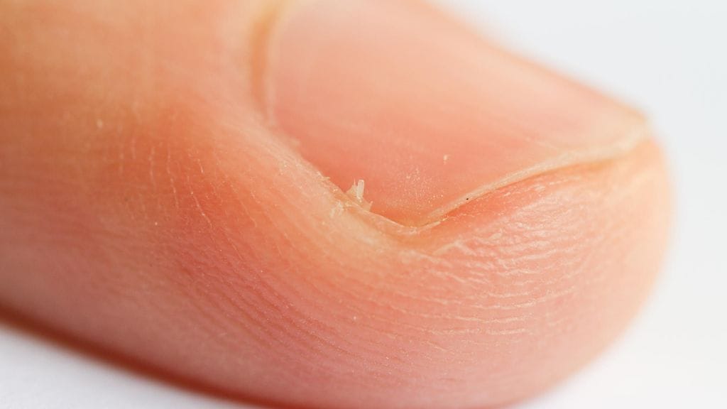 Kynsipiikki on pieni mutta kivulias.