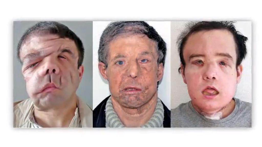 Jérôme Hamon kasvojensiirto