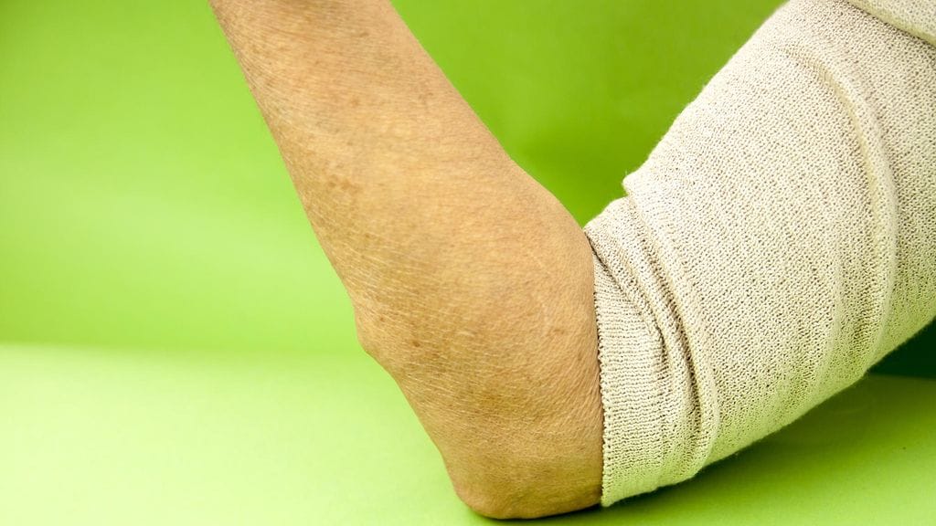 nivelreuma kyynärtaive