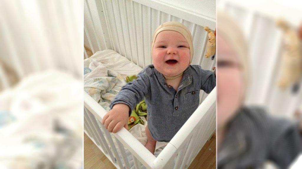 Palovammaan kehittynyttä keloidia on hoidettu ensipainehoidolla, uimapukumaisella myssyllä.