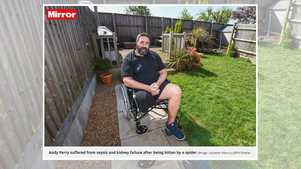 Andy Perry on kenties ensimmäinen britti, joka menetti koko jalkansa hämähäkin takia. Kuvan lähde Mirror