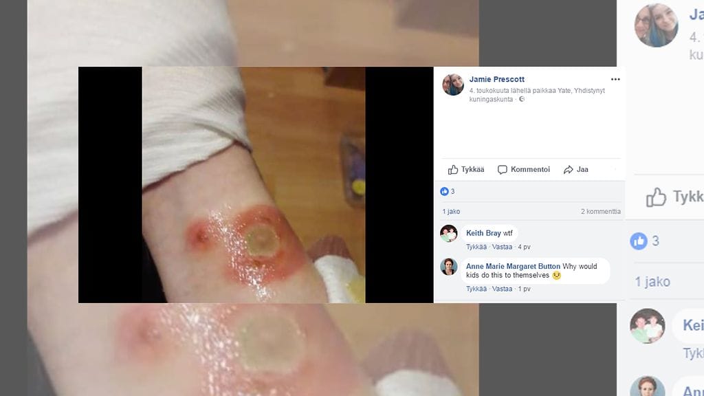 Jamie Prescott julkaisi kuvat vammoista Facebookissa varoittaakseen muita vaikutuksista, joita aerosolideodoranttien pitkällä suihkuttamisella iholle voi olla.
Kuvan lähde Facebook