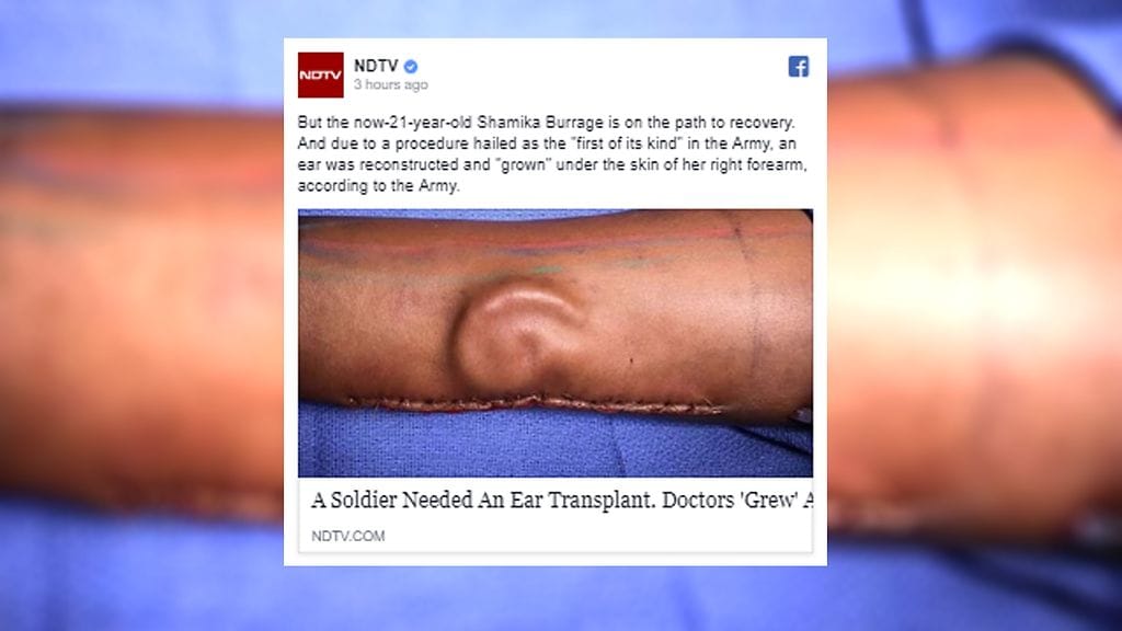 Lääkärit kasvattivat korvan sotilaan kyynärvarteen.