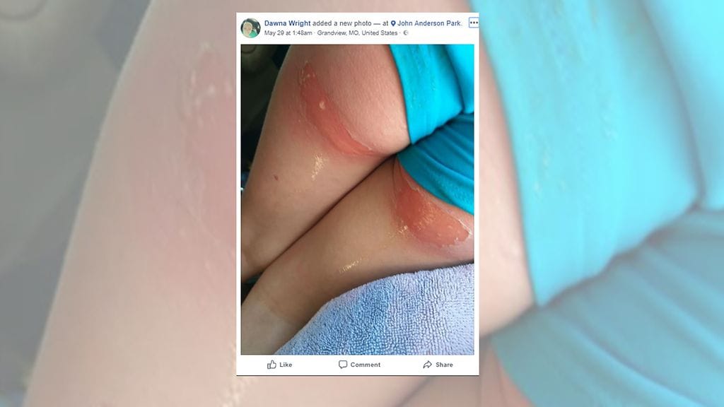 Tulikuuma liukumäki aheutti tytölle toisen asteen palovamman.