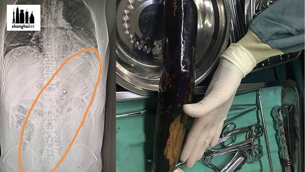 Kiinalaismies yritti hoitaa ummetustaan munakoisolla. Kuvien lähde Shanghaiist