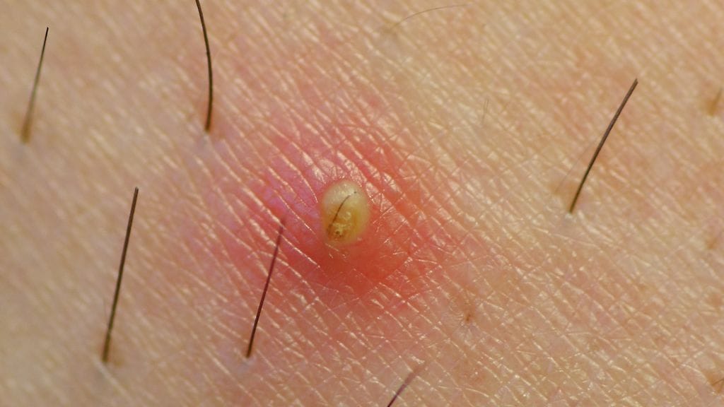 sisäänkasvanut karva