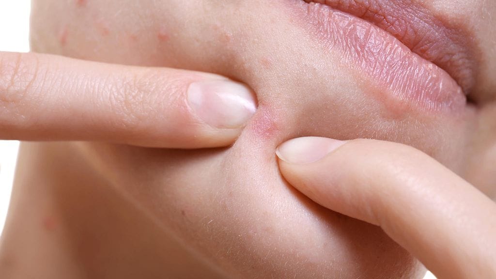 Useimmissa tapauksissa nyppiminen vain pahentää näppylää.