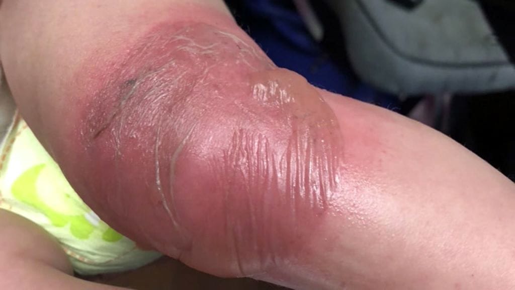 Alexander-poika paloi päivähoidossa kylvyn aikana. Kuva CNN