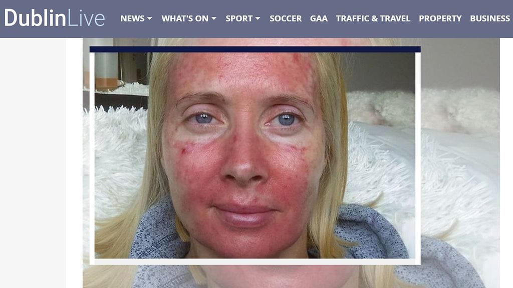 Margaret Murphy otti aiemmin paljon aurinkoa. Nyt hän valistaa muita auringon vaaroista. Kuvan lähde Dublin live