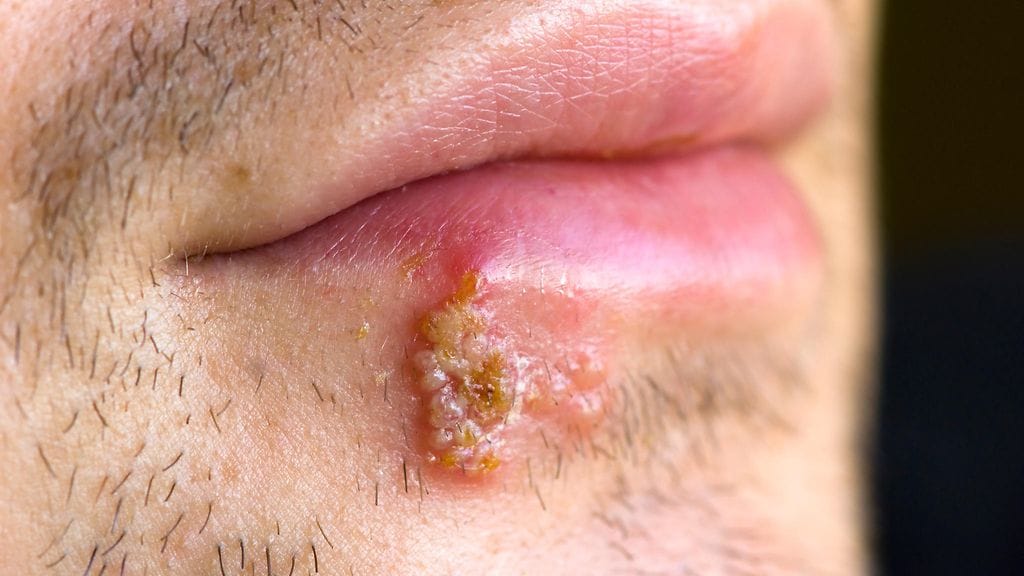 Herpes on kivualias ja kiusallinen elämänkumppani.