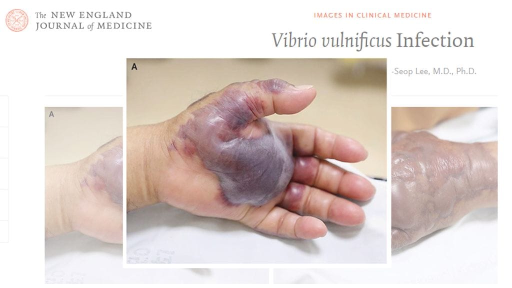 71-vuotiaan miehen käsi piti amputoida raa'an kalan välityksellä tarttuneen bakteerin vuoksi. Kuvien lähde nejm.org