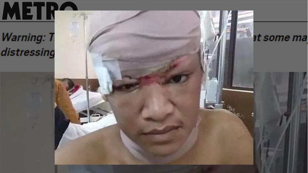 Karmean onnettomuuden seurauksena Guyguy Salvador menetti hiuksensa – ja melkein henkensä. KuvanlähdeMetrocouk