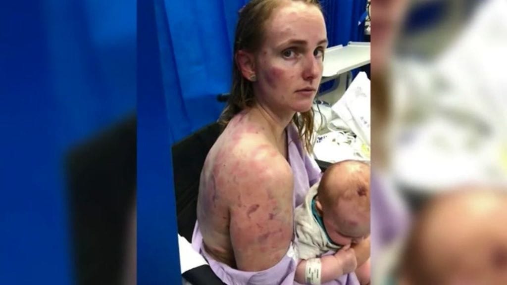 23-vuotias Fiona Simpson sai pahoja ruhjeita suojatessaan vauvaansa tuhoisalta raekuurolta.