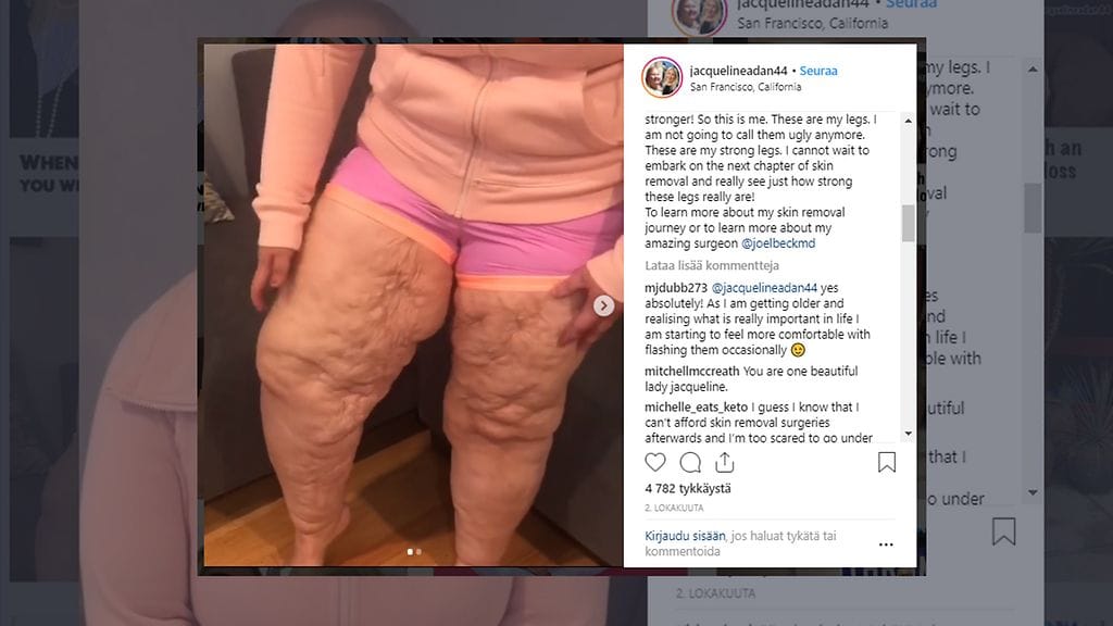 Jacqueline Adan pudotti huikeat 150 kiloa. Operaatio jätti paljon ylimääräistä ihoa hänen jalkoihinsa, jotka hän nyt esittelee videolla. Kuvan lähde Instagram