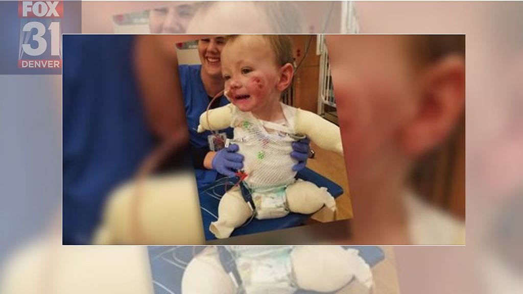 2-vuotias Jeremiah sairastui aluksi vain kuumeeseen. Lopulta lapsi menetti osan kaikista raajoistaan.
Kuvan lähde Fox 31, Facebook