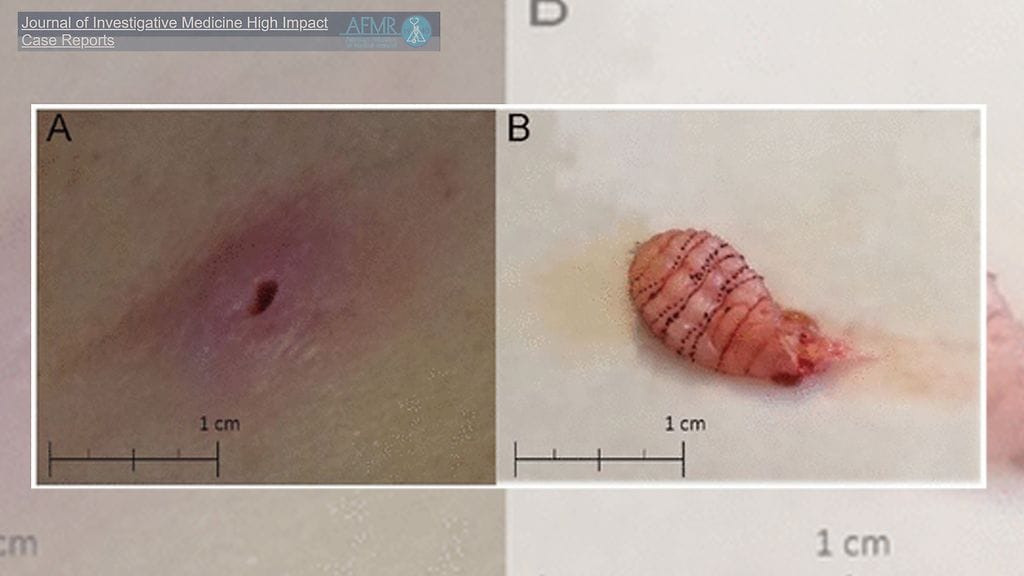 Häämatkan kuuluisikin olla ikimuistoinen – mutta ei sentään tällä tavalla! 36-vuotiaan naisen reiteen pesiytyi loman aikana loinen. Kuvan lähde Journal of Investigative Medicine High Impact Case Reports